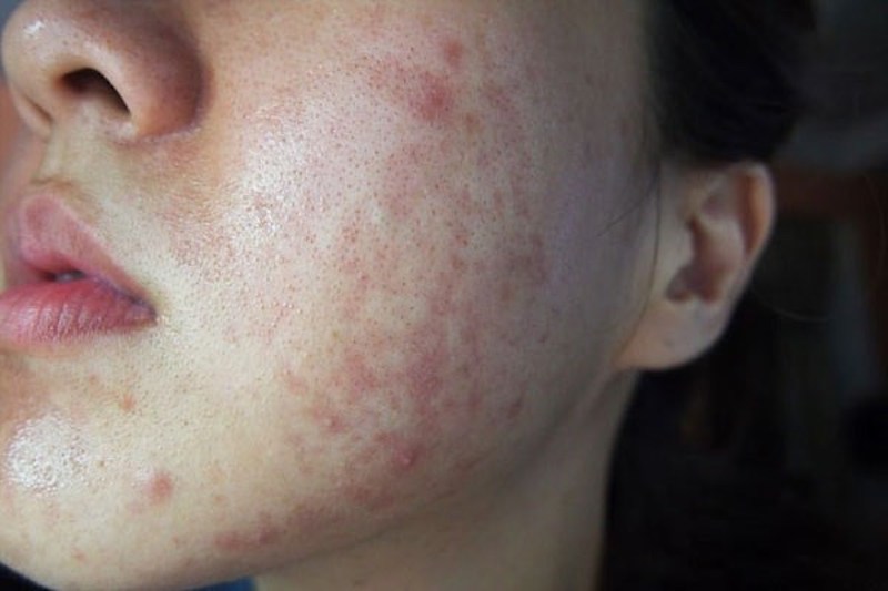 Cấu trúc da mỏng yếu do thiếu hụt collagen