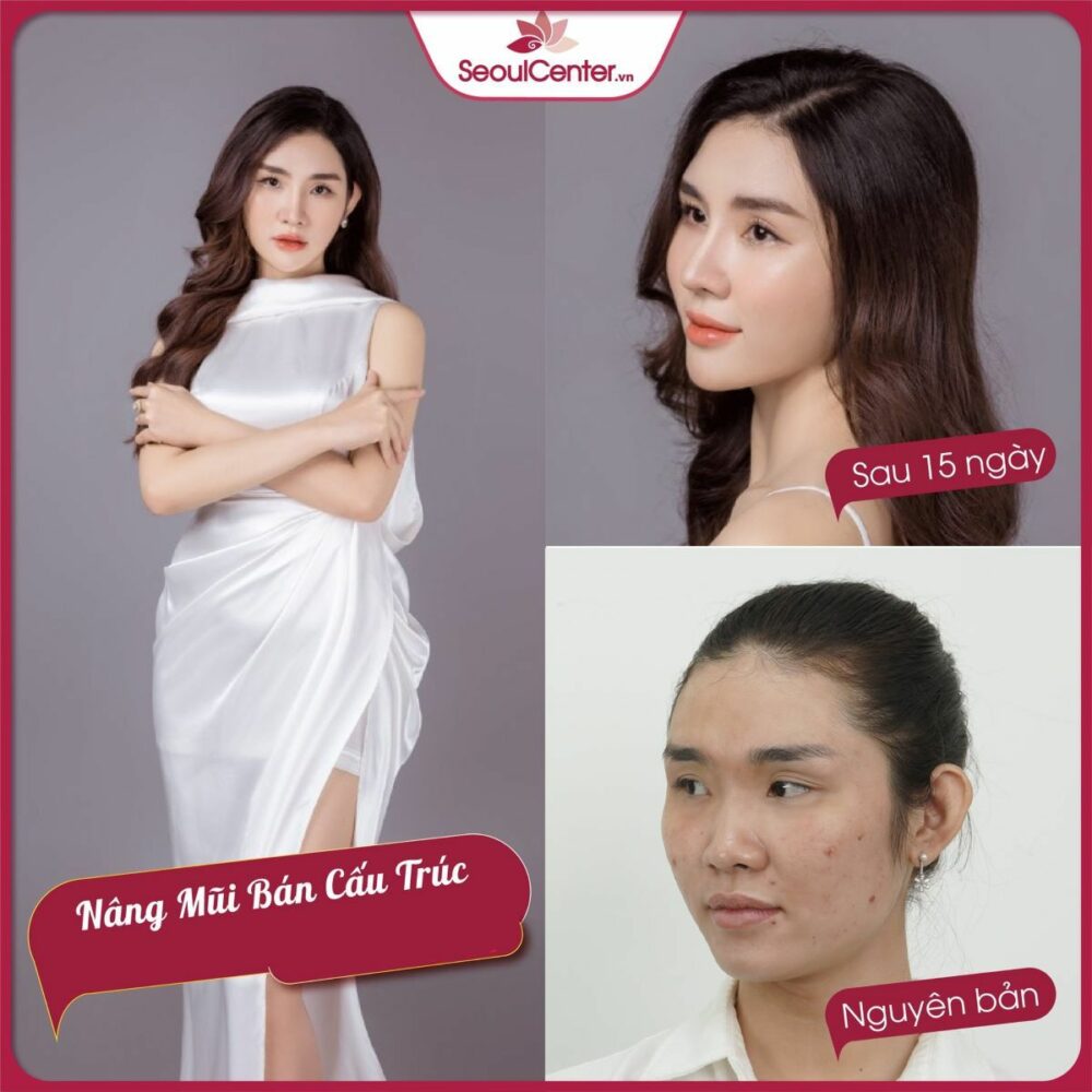 Nâng mũi giúp mang lại cho bạn vẻ ngoài xinh đẹp, thu hút hơn