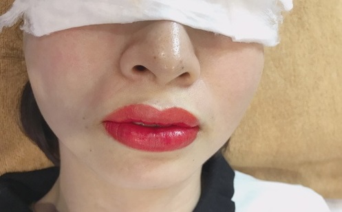 Môi hơi sưng, căng cứng sau khi phun Môi hơi sưng, căng cứng sau khi phun