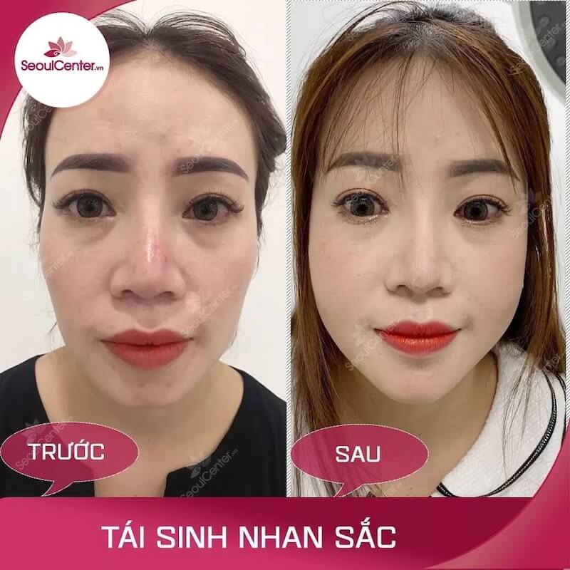 Làn da có sự khác biệt rõ rệt trước và sau khi thực hiện tái sinh nhan sắc