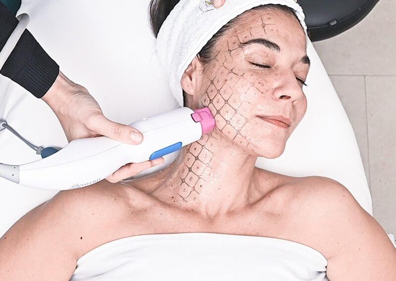 Công nghệ Thermage FLX giúp cho da săn chắc nhanh chóng