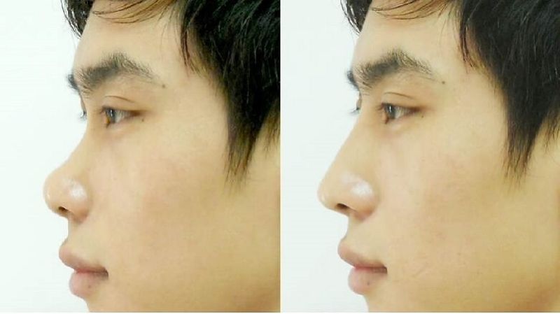Nâng mũi bán cấu trúc 5D là công nghệ tái cấu trúc mũi có phạm vi tác động ở mức độ vừa phải