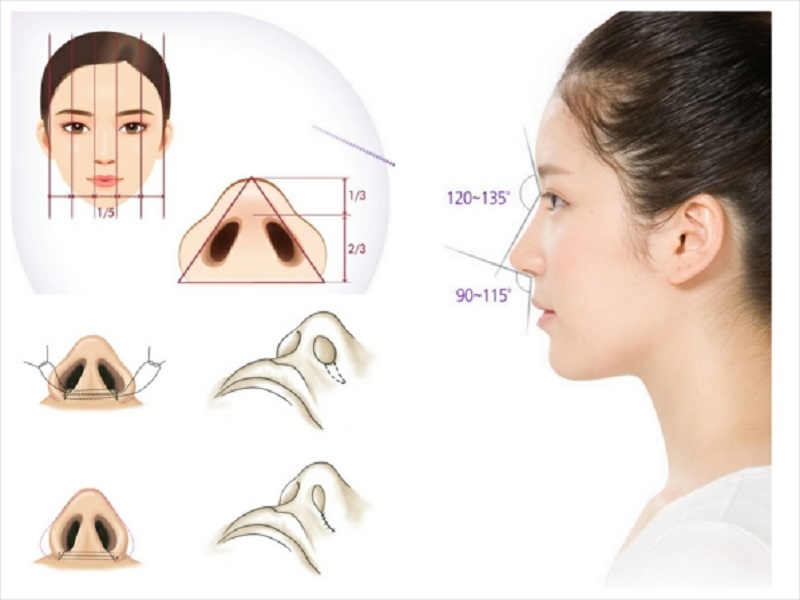 Phương pháp thu gọn cánh mũi được áp dụng an toàn và chuyên biệt