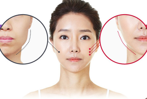 Làm đẹp bằng cách tiêm botox có rất nhiều lợi ích