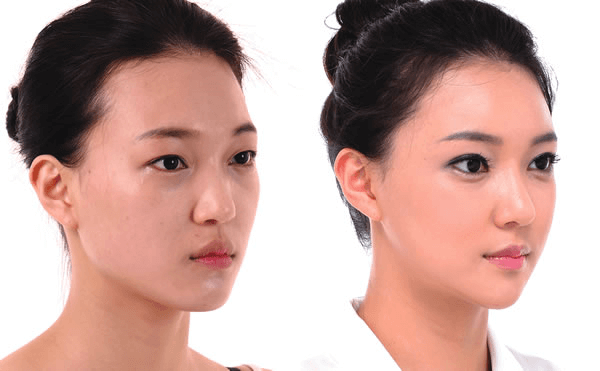 Filler giúp làm đầy vùng da, xóa bỏ rãnh sâu duy trì trong khoảng thời gian nhất định