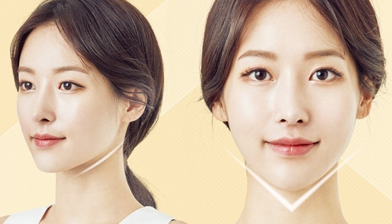 Chăm sóc đúng cách sau khi tiêm filler để có dáng cằm đẹp tự nhiên