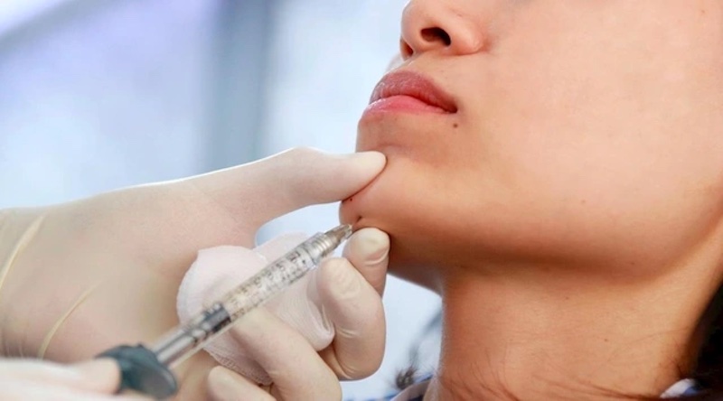 Mỗi gương mặt thường chỉ cần từ 1 – 3cc filler là đủ