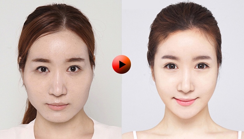 Filler có thể duy trì được từ 1 – 2 năm sau khi thực hiện