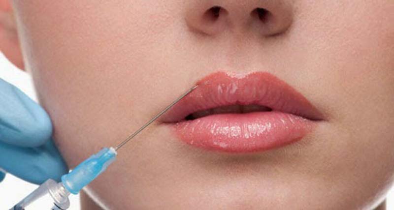 Tiêm filler môi trái tim, môi cười là xu hướng thẩm mỹ mới nhất hiện nay