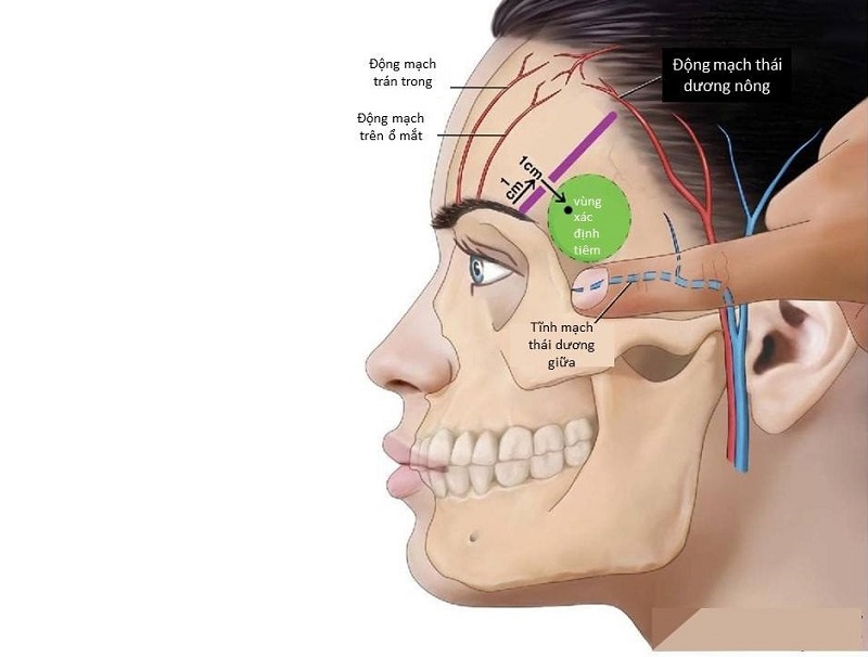 Phương pháp tiêm filler thái dương thực hiện an toàn, chuyên biệt
