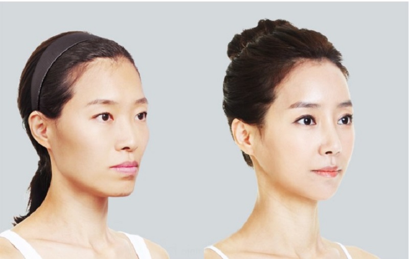 Kết quả thực tế sau khi tiêm filler thái dương an toàn