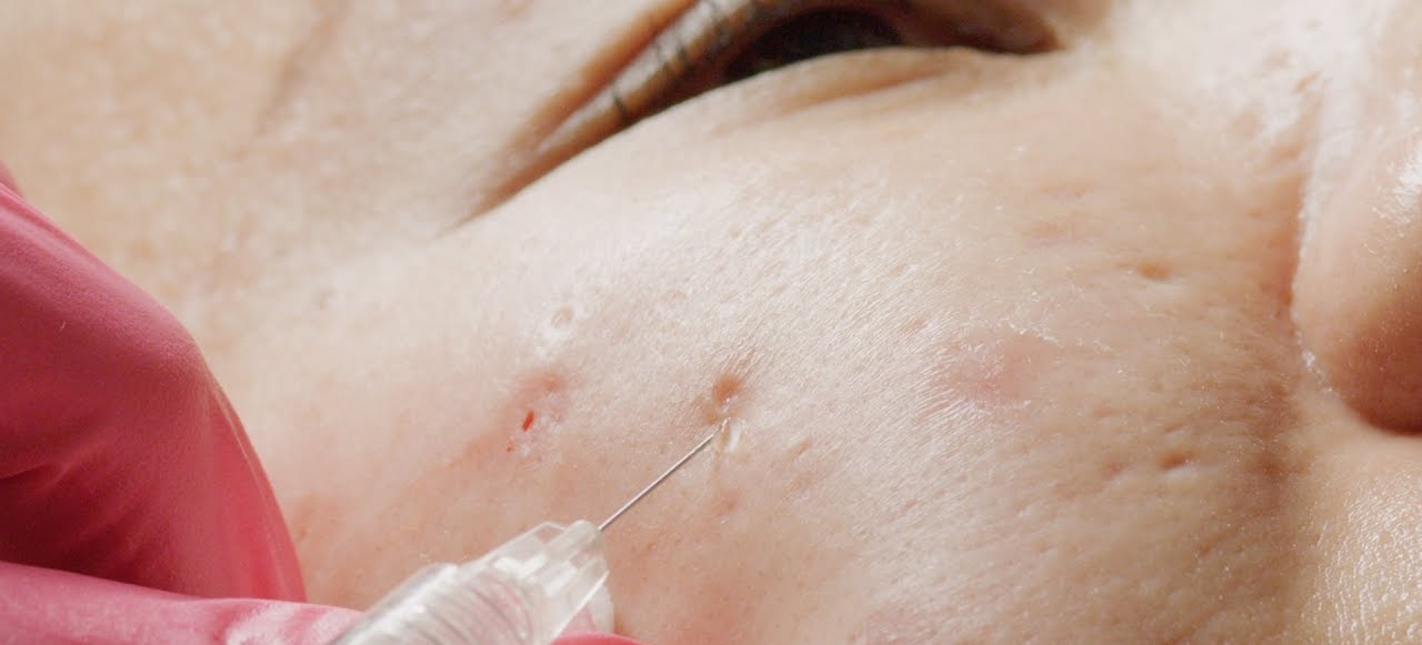 Tiêm filler mau chóng lấp đầy vùng sẹo lõm