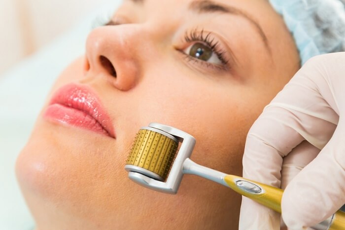 Sẹo lõm mờ dần sau mỗi lần áp dụng công nghệ điều trị theo liệu trình từ 3 – 5 buổi