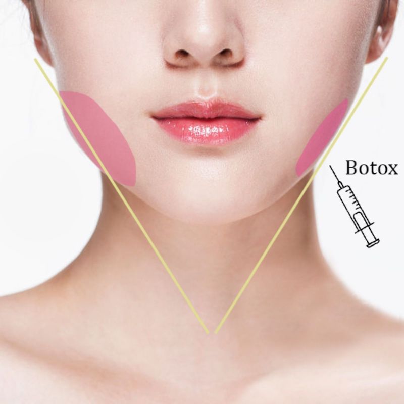 Tiêm dặm botox định kỳ để duy trì hiệu quả làm đẹp