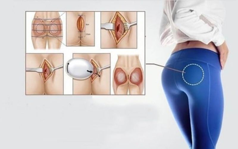 Độn nâng mông giúp sở hữu vòng 3 chuẩn như SAO thế giới