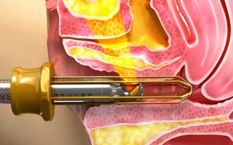 Tác động của laser nhẹ nhàng, êm ái