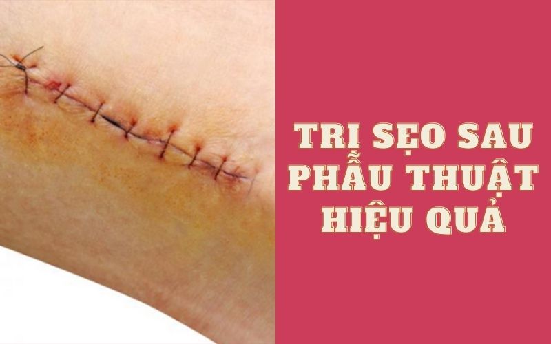 Bí quyết vàng giúp trị sẹo khâu sau phẫu thuật hiệu quả