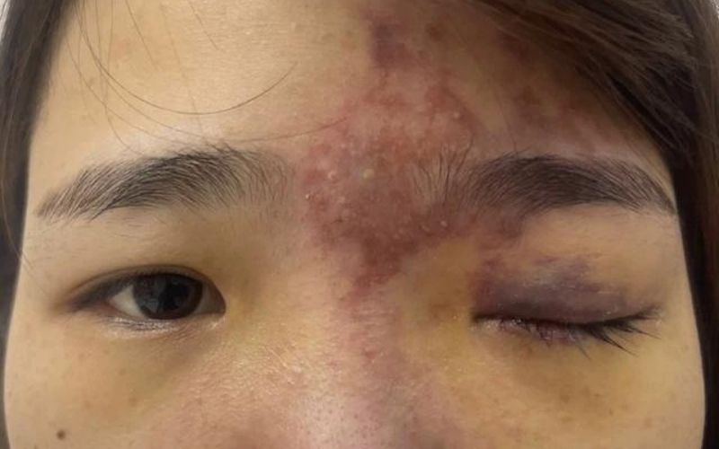 Tiêm filler bị sưng, bầm tím do tiêm sai kỹ thuật