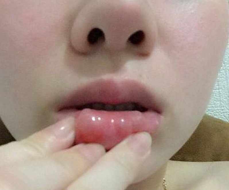 Vùng tiêm filler bị vón cục là biểu hiện thường gặp