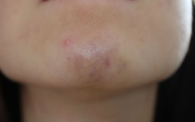 Vùng tiêm filler bị kích ứng, sưng đau nhẹ