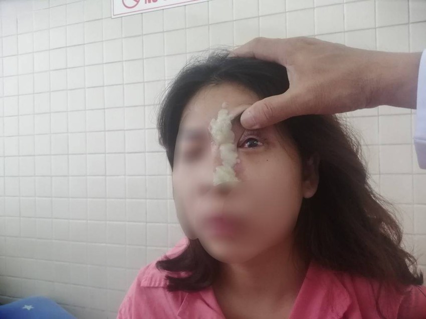 Tiêm filler mũi gây tắc mạch dẫn đến mù mắt