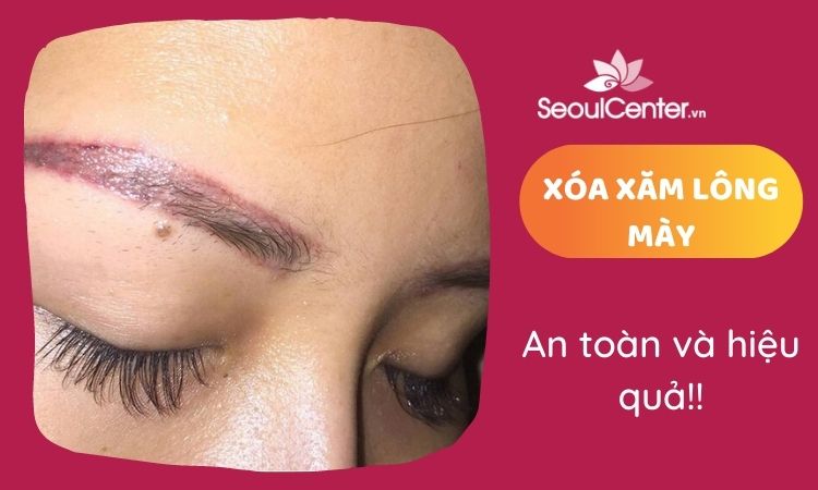 Xóa xăm lông mày và những điều quan trọng bạn cần biết