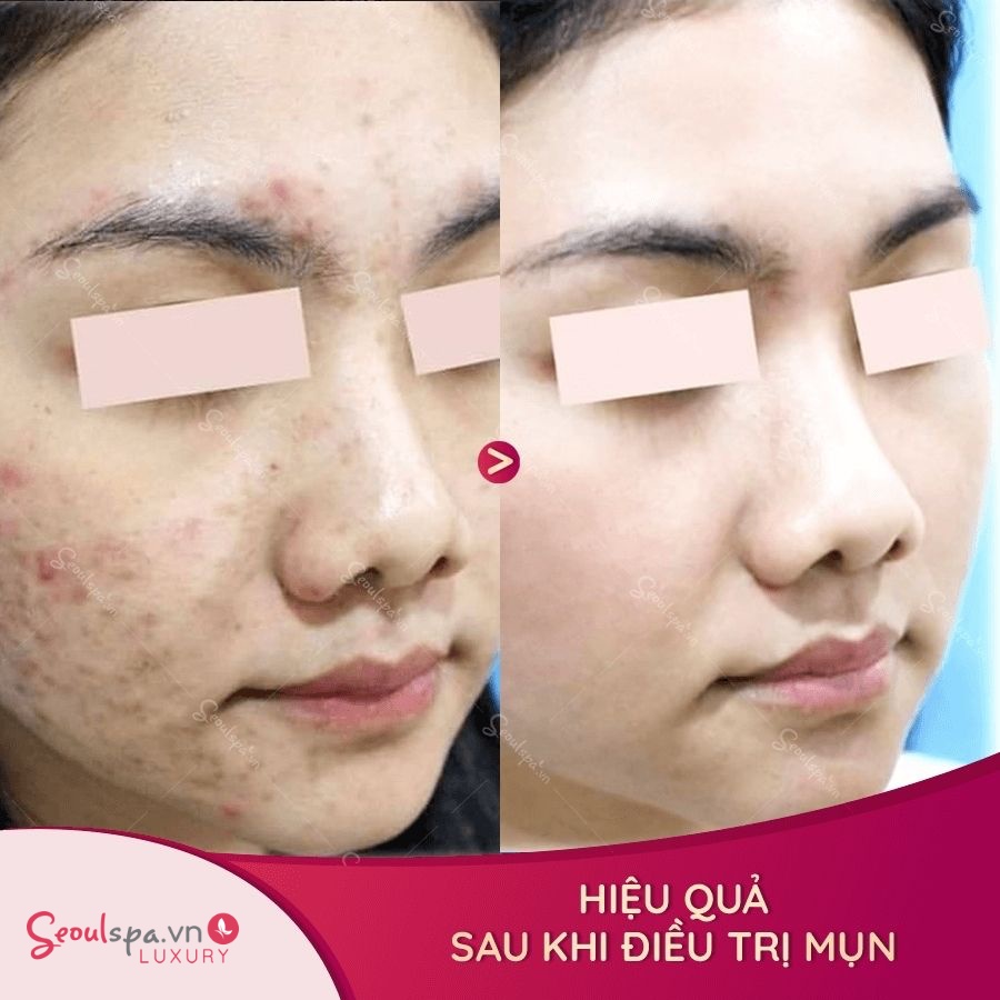 - Hiệu quả điều trị của khách hàng sau khi sử dụng dịch vụ điều trị mụn chuyên sâu