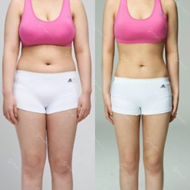 Giảm béo bằng công nghệ cao vô cùng an toàn