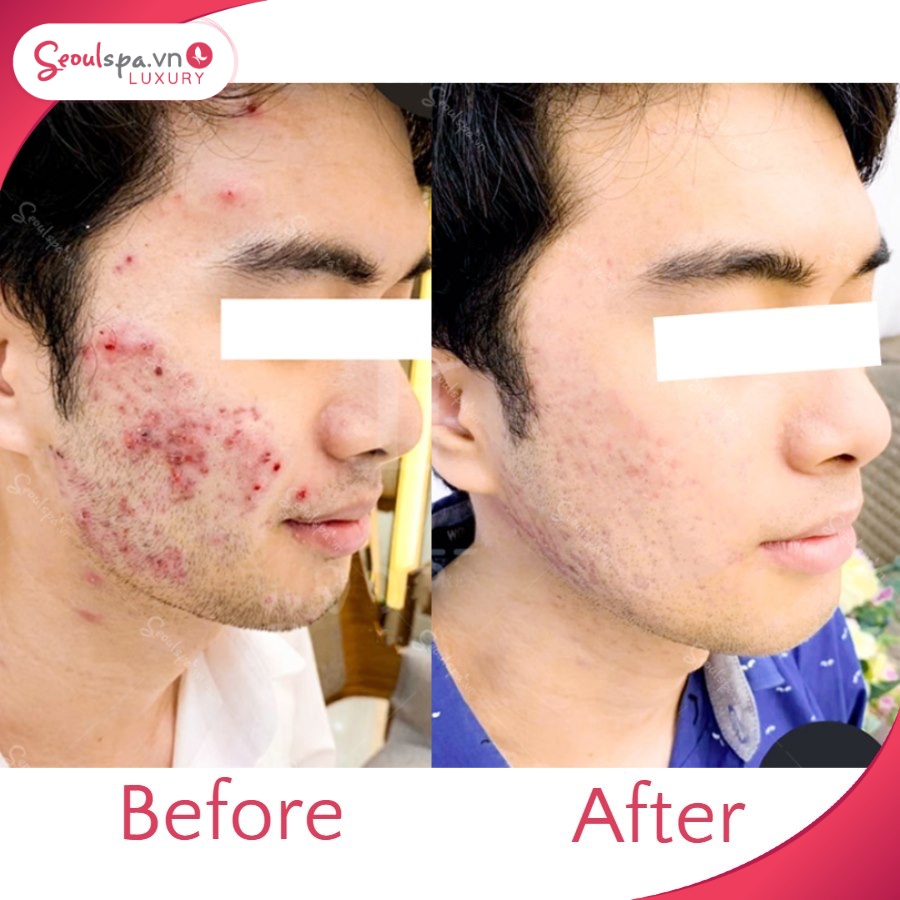 Da sáng mịn và tự nhiên sau khi kết thúc liệu trình trị mụn an toàn