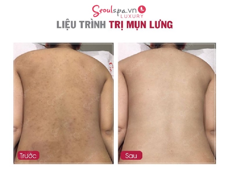 Nhiều khách hàng ngỡ ngàng trước kết quả trị tại Seoul Luxury