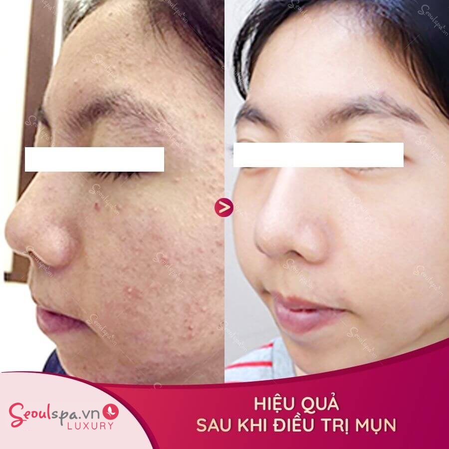 Chị Thanh Hằng trước và sau trị mụn tảo Silic