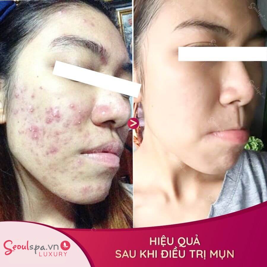 Làn da chằng chịt mụn cám, mụn mủ đã lán mịn, không tỳ vết