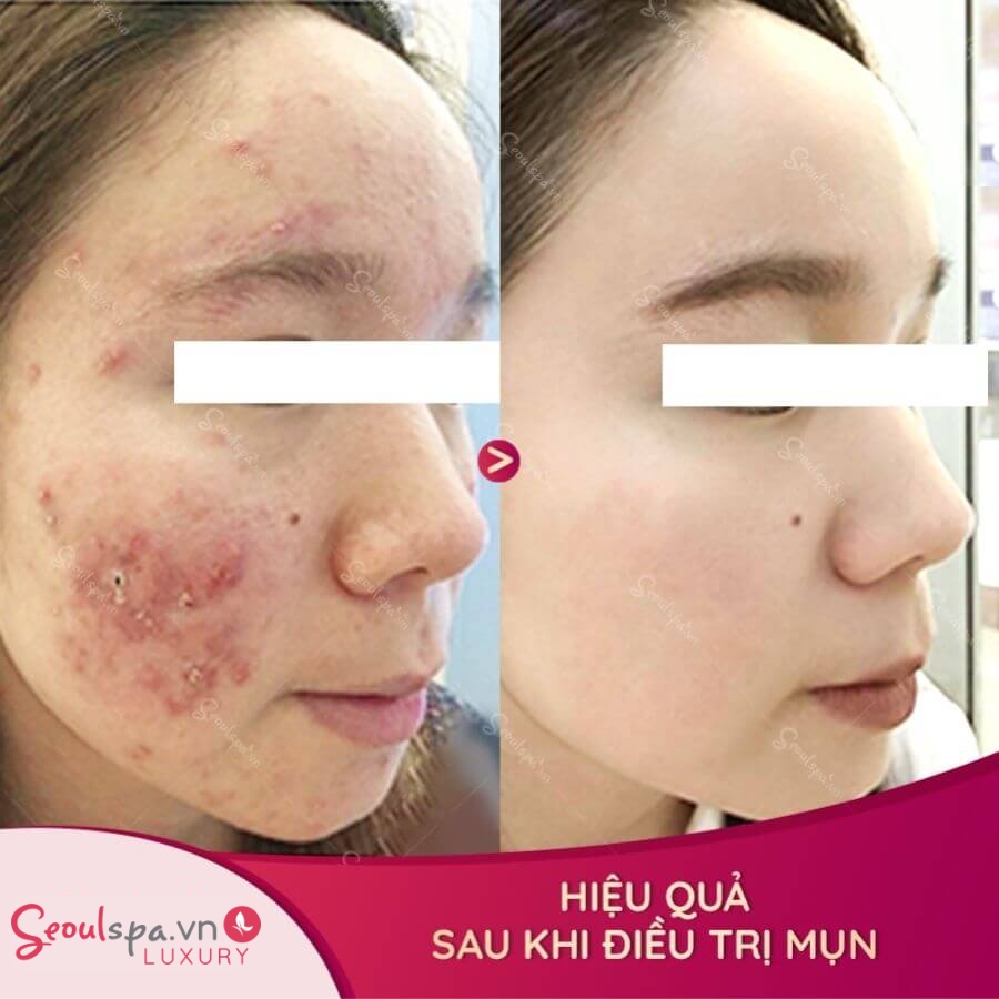 Ổ mụn ở má tái đi tái lại đã được trị tận gốc sau trị mụn tảo Silic