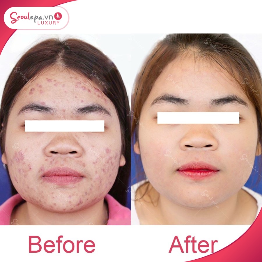 Da sáng mịn và tự nhiên sau khi điều trị mụn tại Seoul Luxury