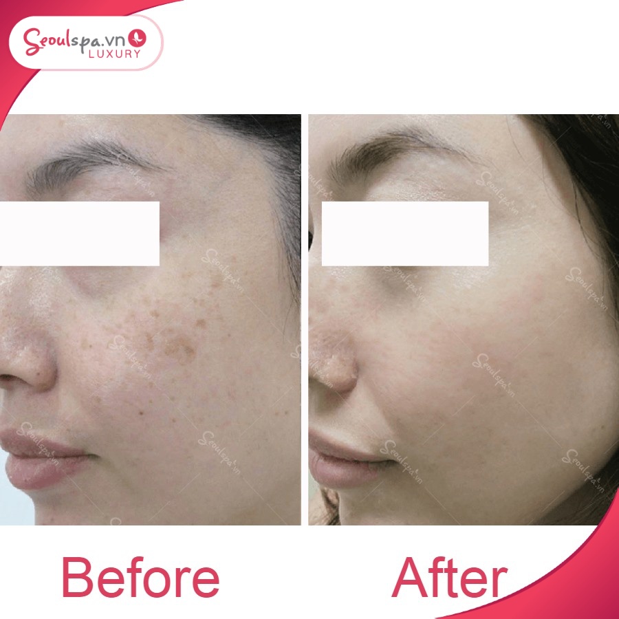 Hiệu quả điều trị nám tại Seoul Luxury làm hài lòng nhiều khách hàng