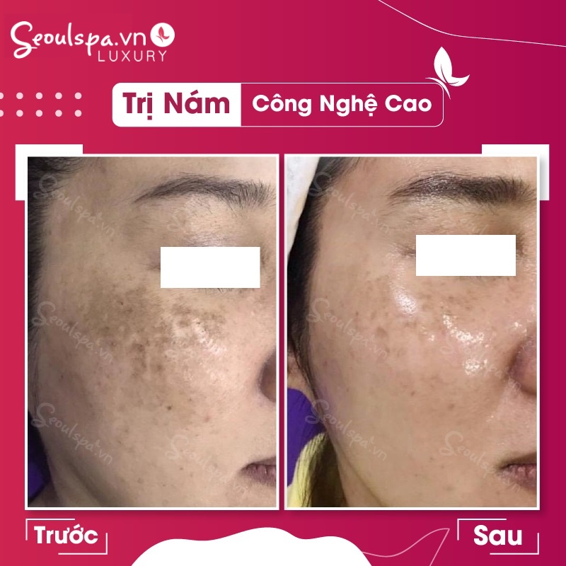 Khách hàng xóa nám hiệu quả tại Seoul Luxury