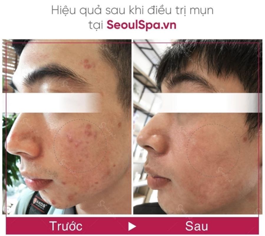 Tình trạng mụn và thâm giảm rõ rệt