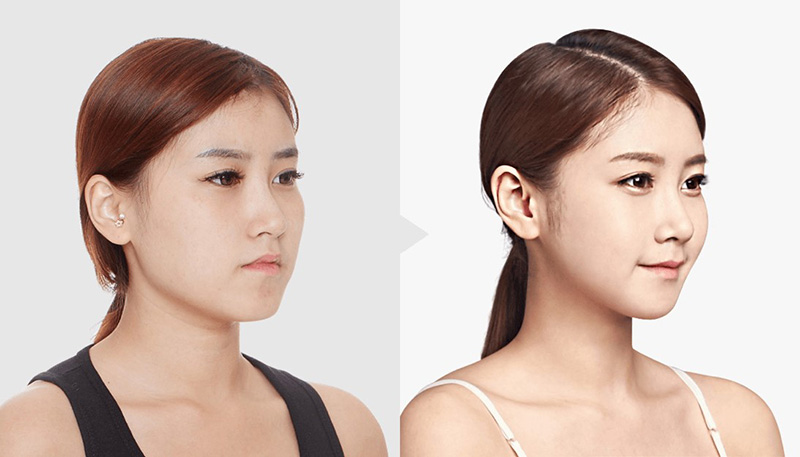 Top 20+ Tiêm Filler Mũi Có Ảnh Hưởng Gì Không Tiêm filler mũi được bao lâu? Có an toàn không? 33 Chăm sóc mũi sau khi tiêm filler xong là bước quyết định hiệu quả của phương pháp làm đẹp cho mũi