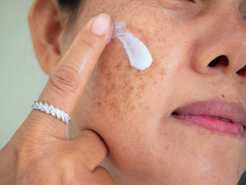 Kem trị nám da là sản phẩm loại bỏ nám phổ biến