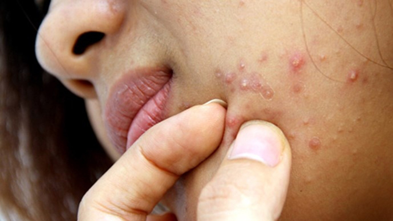Thói quen dùng tay nặn mụn