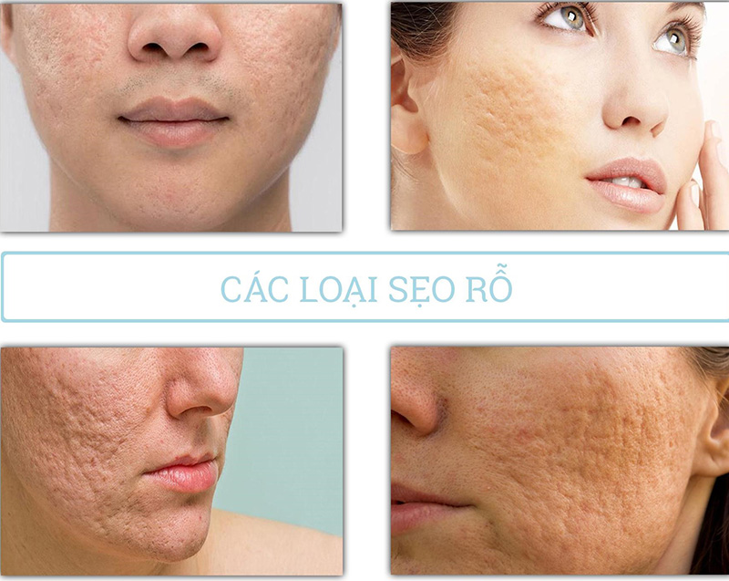 Phân loại các dạng sẹo