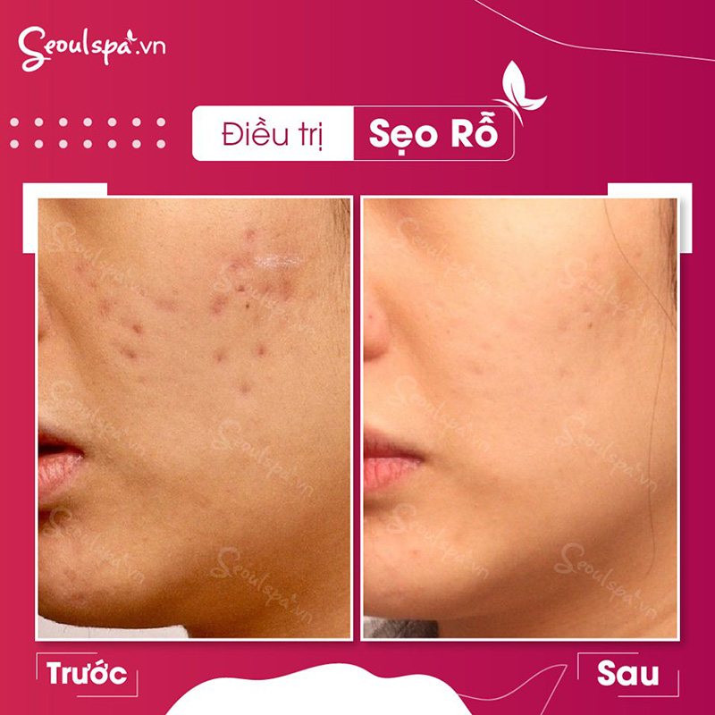 Trị sẹo Micro kết hợp với OxyJet