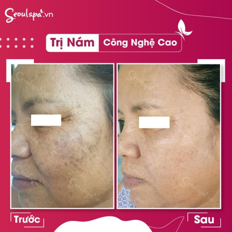 Trị dứt điểm tình trạng nám da tại Thẩm mỹ viện Seoul spa Cần Thơ