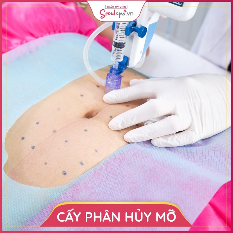 Giảm béo bằng phương pháp cấy phân hủy mỡ