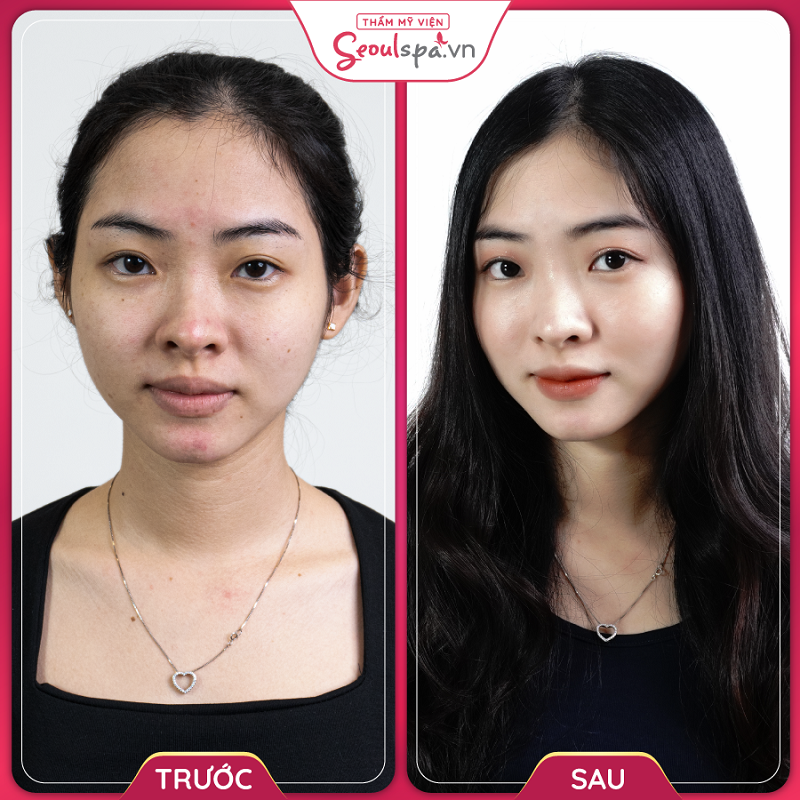 Điều trị mụn tại Seoul Spa để lấy lại làn da đáng mong đợi