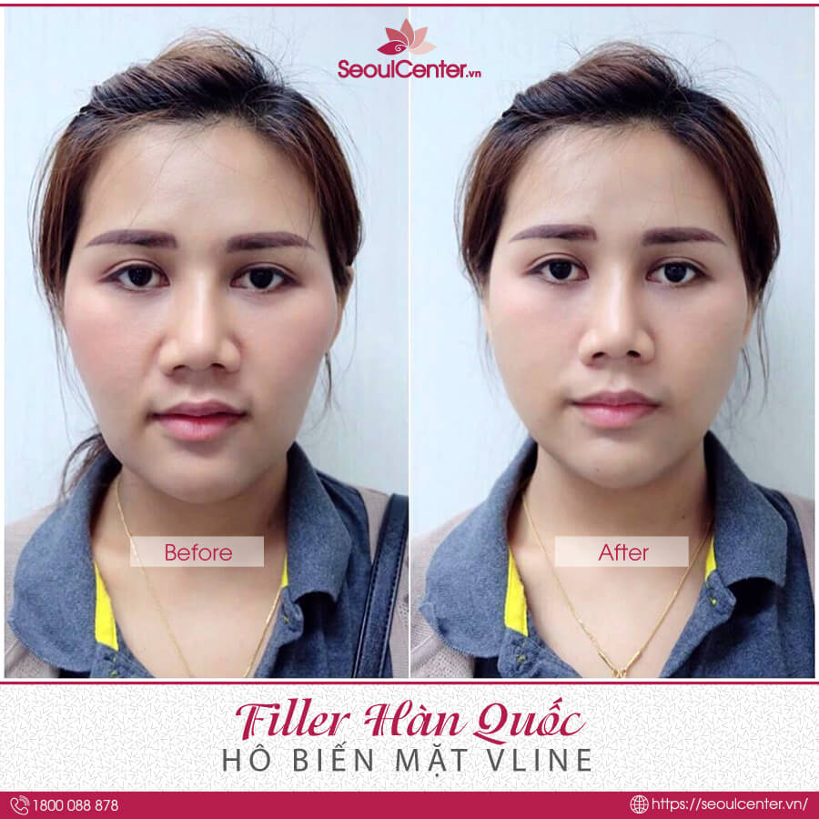 Hiệu quả khách hàng khi tiêm Filler tại Seoul Center