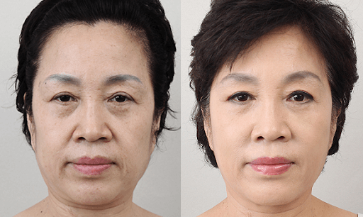 Cấy collagen đa nguyên bào xóa đi rãnh cười giúp gương mặt trông trẻ trung hơn
