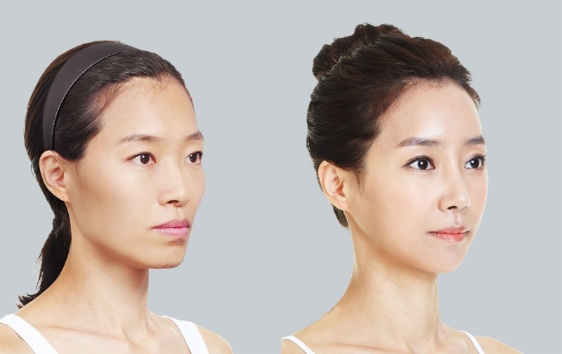 Những người từ 25-50 tuổi trên gương mặt có những dấu hiệu lõm, hóp khiến gương mặt thiếu cân đối