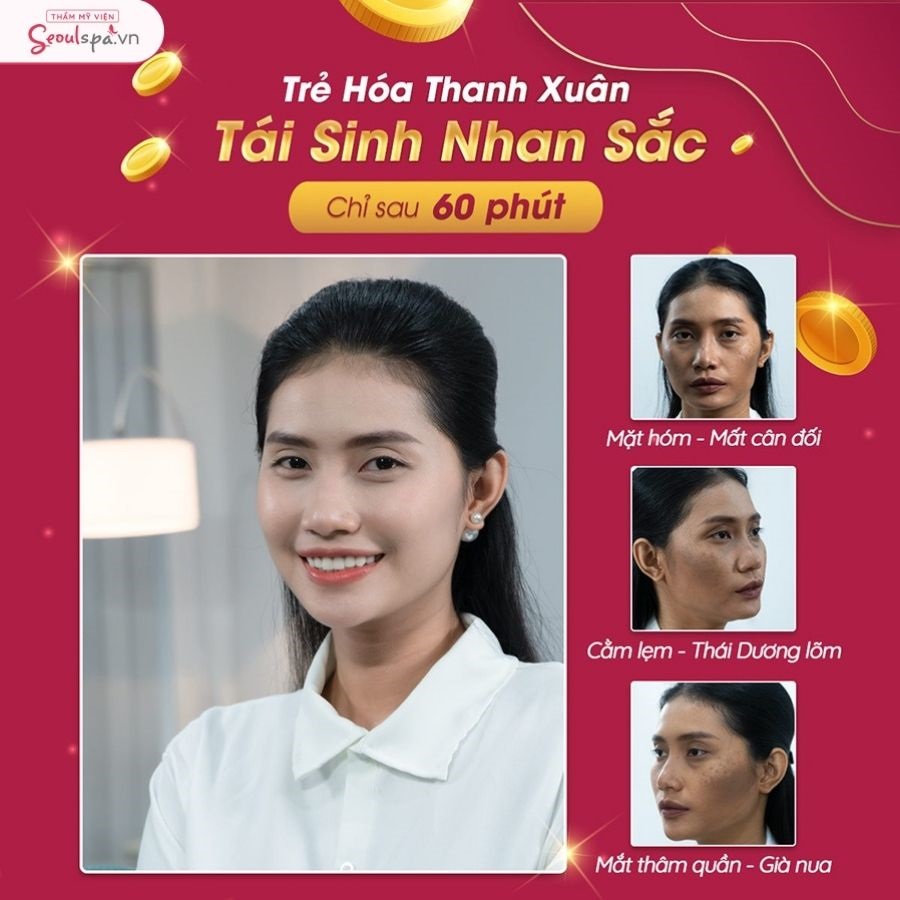 Cấy collagen đa nguyên bào giúp gương mặt đầy đặn, hài hòa và trẻ trung hơn
