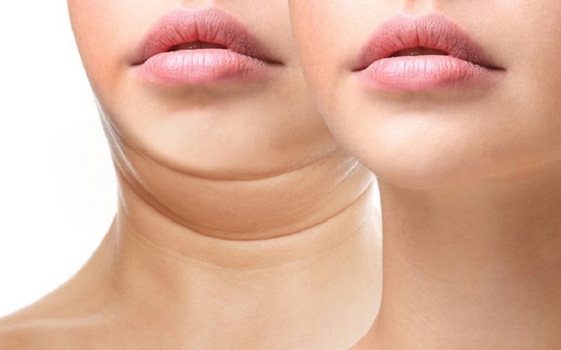 “Cằm đôi” đã biến mất sau khi cấy tiêu hủy mỡ nọng cằm